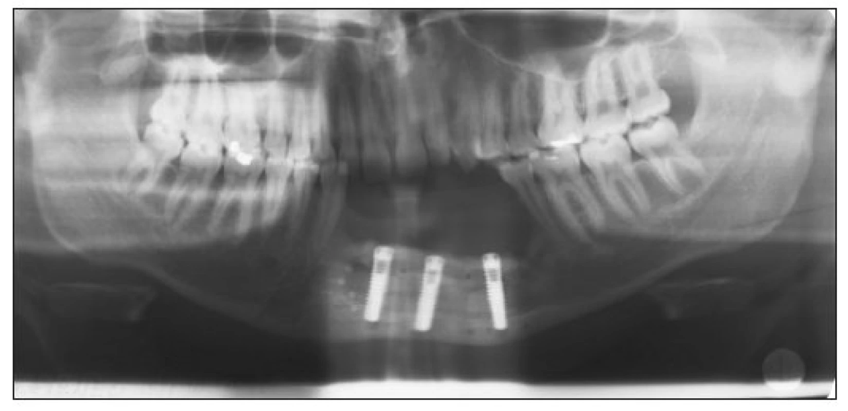Three implants (STI-BIO Impladent Lasak)