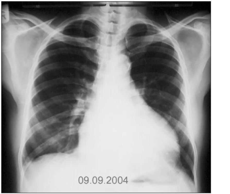 RTG srdce a plic (9. 9. 2004): Srdeční stín hraniční velikosti, hrotem do medioklavikulární čáry, levostranný výpotek regredoval, ostatní nález stacionární.