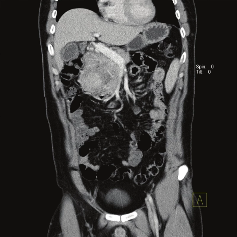 CT obraz útlaku hepatoduodenálního ligamenta tumorem retroperitonea – koronární řez
Fig. 2: CT image of compression hepaduodenal ligament caused by retroperitoneal tumor (coronal)