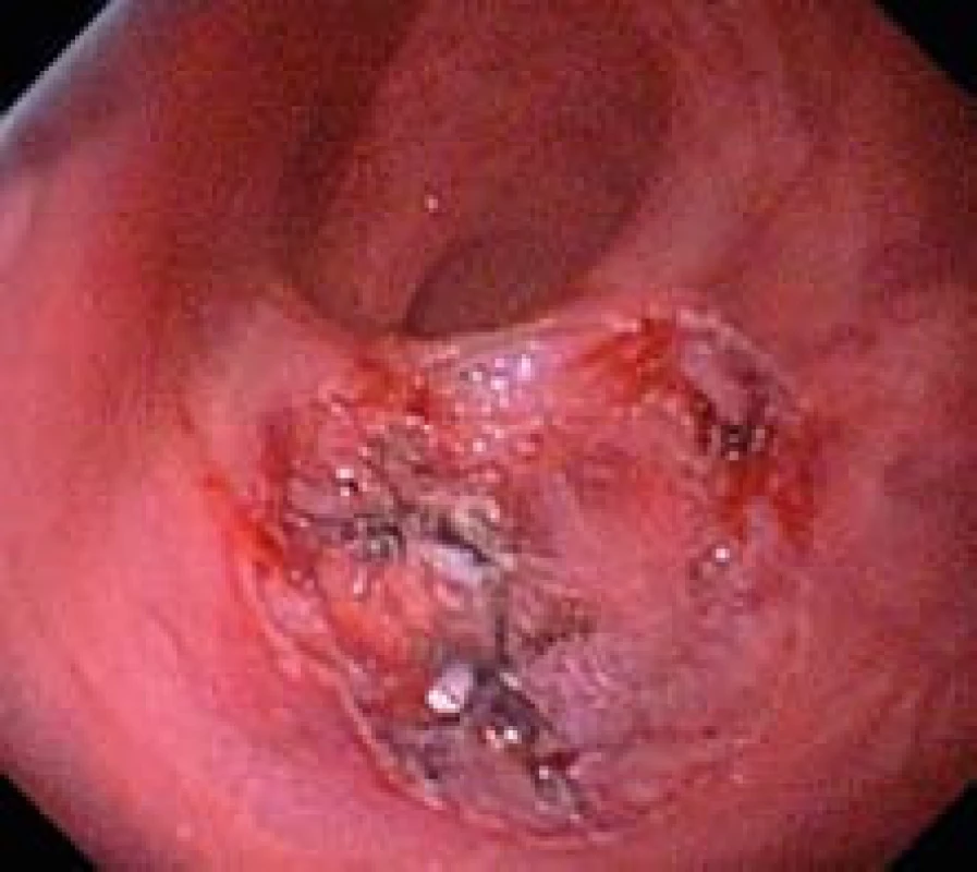 Spodina po ESD . Submukózní cévy ošetřeny koagulací a klipem.
Fig. 6. Defect after ESD. Submucosal vessels treated with clips.