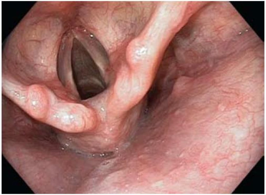 Fyziologický nález v hrtanu a hypofaryngu.
Fig. 1. Normal larynx and hypopharynx.