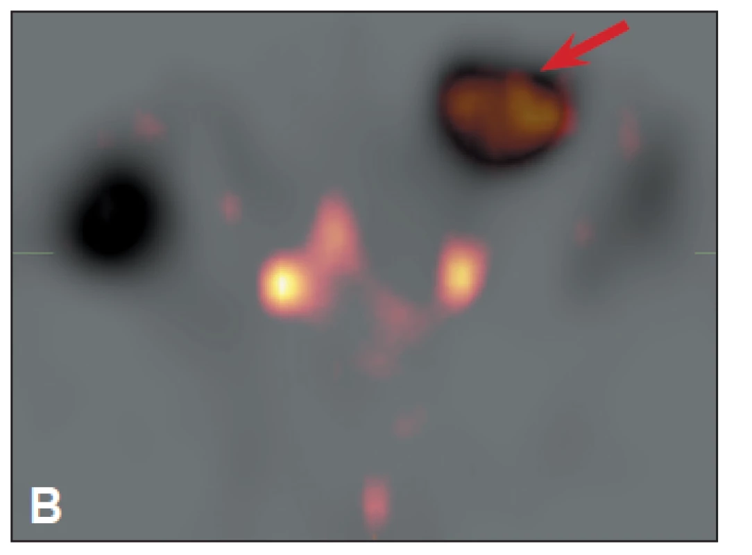 <i>SPECT fúze obrazů s denaturovanými erytrocyty a s Octreoscanem</i>