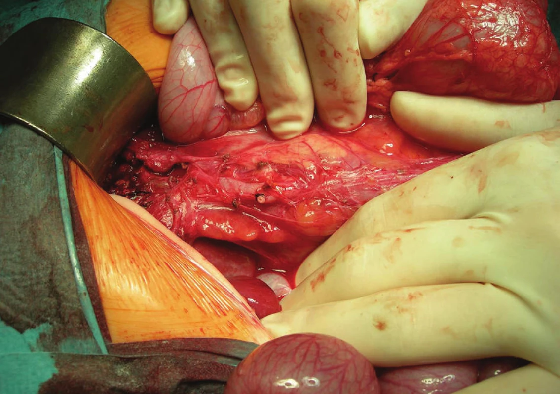 Stav po resekcii oboch útvarov
Fig. 6. Postoperative state after the total resection of both
cystic lesions