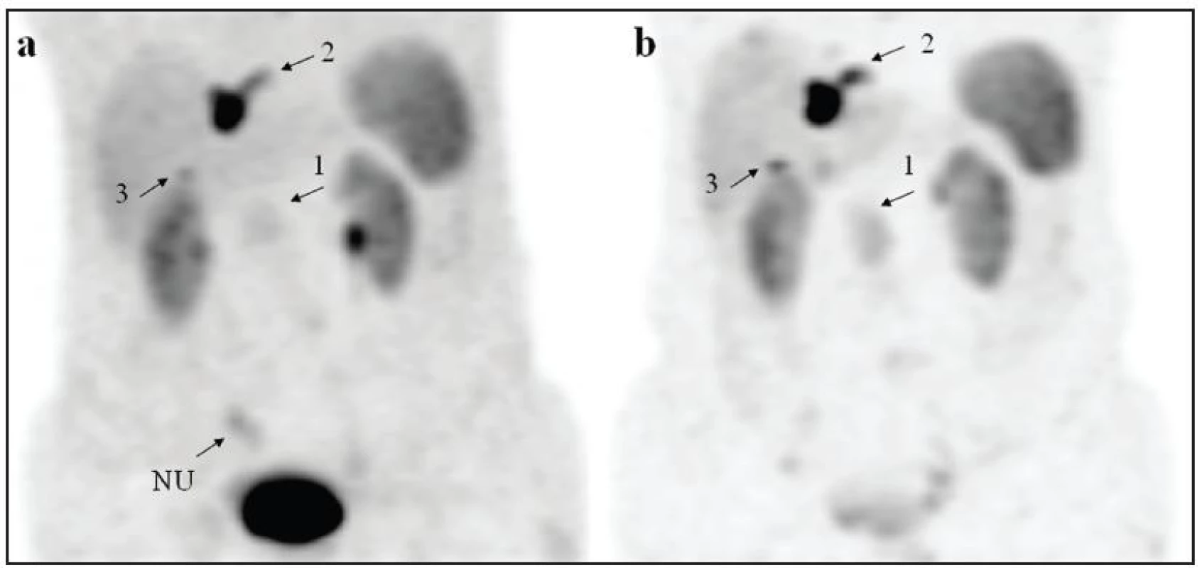 Snímky MIP (maximum intensity projection) u pacienta s karcinoidem tenkého střeva z obrázku 1. Pruhovitý nespecifický uptake radiofarmaka (NU) je zobrazen na snímku (a) získaném za 1 hodinu po aplikaci, na snímku za 4 hodiny (b) již není přítomný. Ložiska 1, 2, 3 nemění v čase svou lokalizaci, je patrný vzestup intenzity a lepší kontrast k tělnímu pozadí na snímku (b).