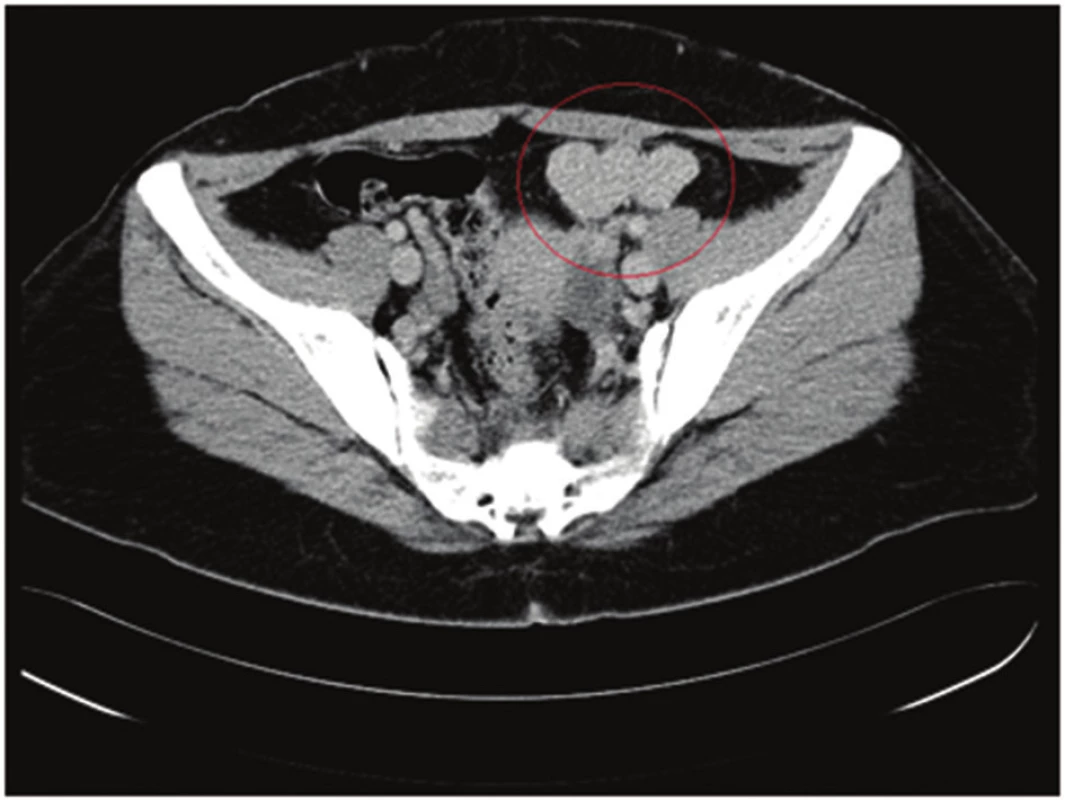Nález homogénneho ložiska v ľavom hypochondriu (splenóza) – v červenom krúžku
Fig. 1: Finding of a homogeneous deposit in the left hypochondrium (splenosis) – in the red circle