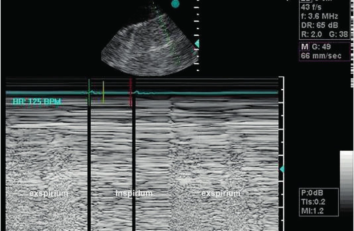 Pneumothorax
Lung point detekovaný transthorakální sondou v přední axilární čáře. M-mode v sektoru nahoře je proložen zónou pneumothoraxu v inspiriu. Normální obraz je v levé části sektoru, která se dostává pod paprsek M-mode v exspiriu.