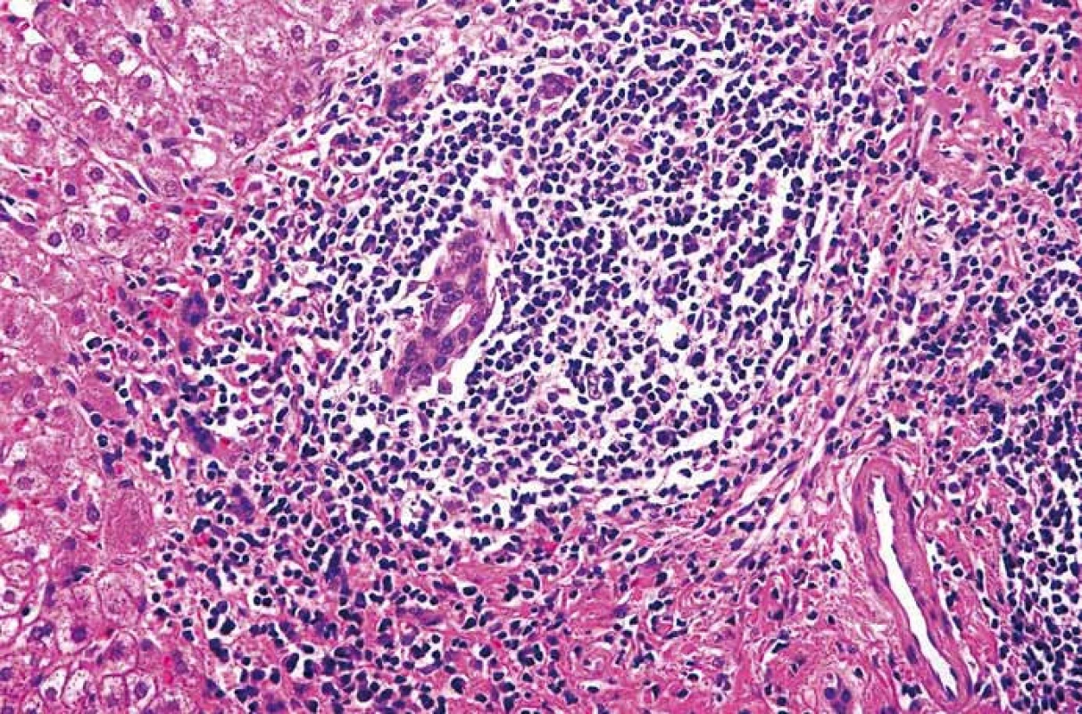 Extranodální lymfom z B buněk marginální zóny. Portální pole s vágně nodulární proliferací malých a středně velkých lymfocytů zčásti centrocytoidního vzhledu. Hematoxylin-eozin, původní zvětšení 400×.
Fig. 2. Extranodal marginal zone B-cell lymphoma. Portal tracts with nodular proliferation of small and medium lymphocytes, some of them with centrocytoid appearance. Haematoxylin-eosin staining, magnification ×400.