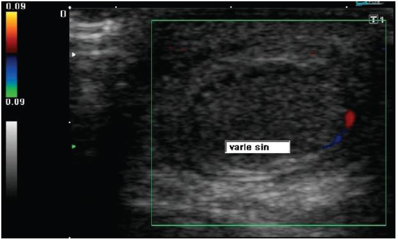 Ultrazvukové vyšetření barevným Dopplerem levého varlete: varle je homogenní, při dolním pólu je patrný signál zachovalé perfúze
Fig. 2: Doppler ultrasonography of left testicle: tissue echostructure is homogeneous, signs of preserved perfusion in the lower pole are detected