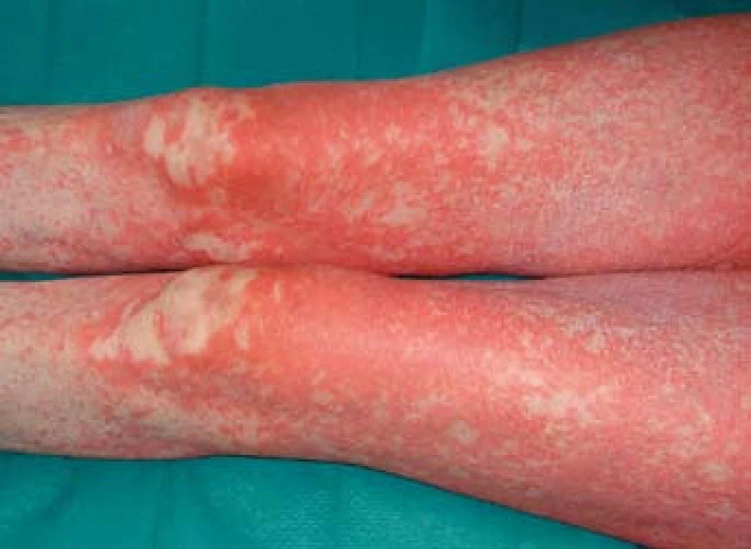 Generalizovaný exantém na dolních končetinách.
Fig. 2. Generalized exanthem in the lower limbs.