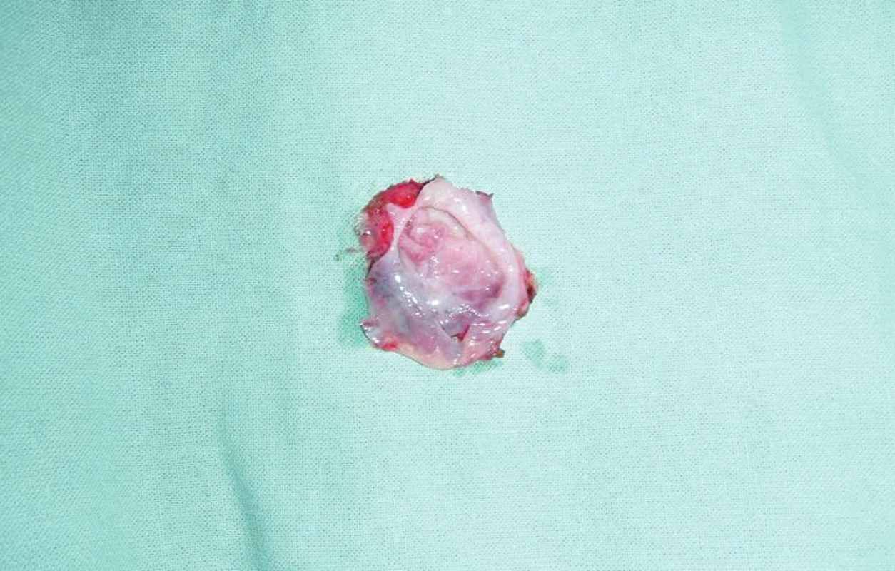 Rozstřižený preparát cysty
Fig. 5: The cyst preparation, cut open