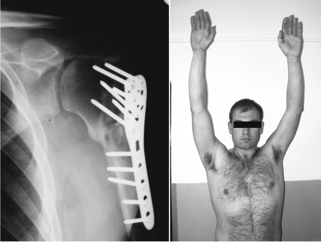 Stav po derotační osteotomii 5 měsíců po operaci. a) RTG snímek 5M po derotační osteotomii, b) klinický nález 5 měsíců po operaci
Pic. 5. A condition 5 months after derotation osteotomy a) a 5M x-ray view after the derotation osteotomic procedure, b) a clinical finding 5 months after the derotation osteotomic procedure