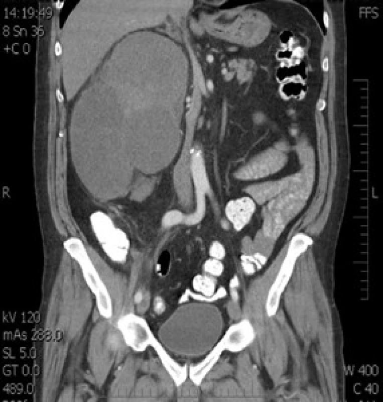 CT snímek tumoru
Fig. 1. CT of tumor