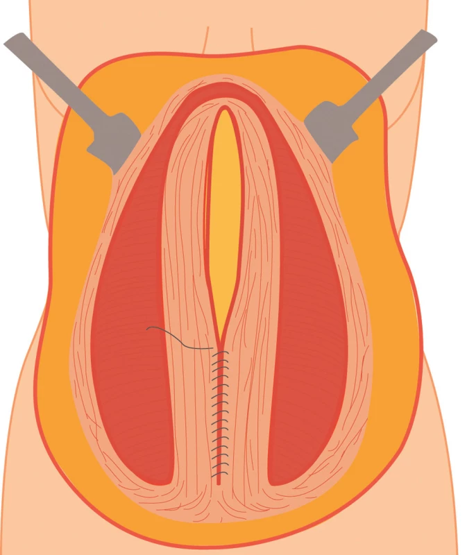 Sutura defektu břišní stěny (kýlní branky) pokračujícím stehem
Fig. 3: Suture of the abdominal wall using continuous suture
