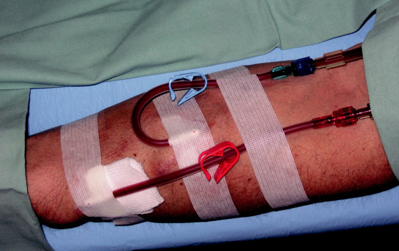 Suspektní formace odpovídající zvětšenému pravému dolnímu příštítnému tělísku (sekundární hyperparathyreóza při selhání ledvin) 