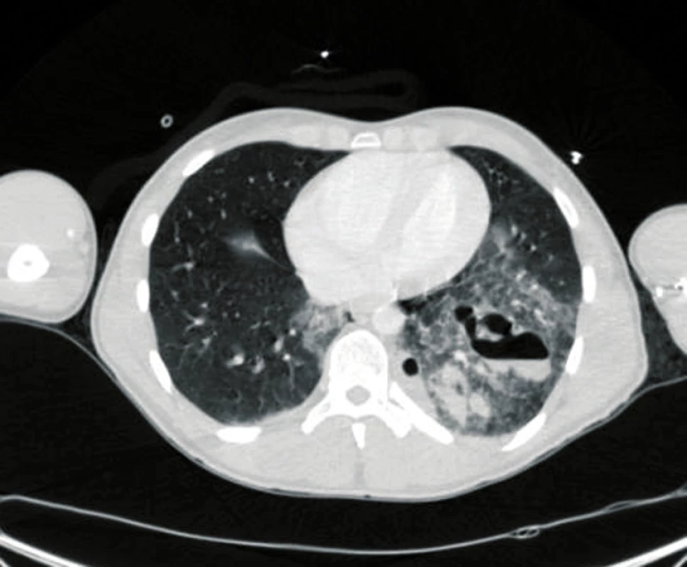Axial CT