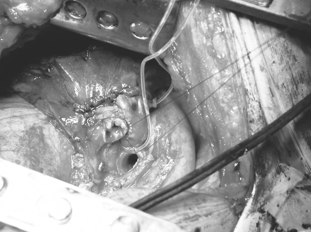 Peroperační snímek – založení prvního stehu bronchiální anastomózy za okraje hlavního a lobárního bronchu
Pic. 1. Peroperative view – First bronchial anastomosis stitch applied to the main and lobe bronchi ends