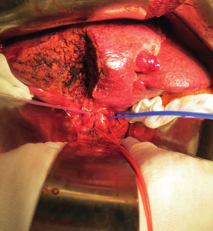 Resekční plocha jater a struktury hepatoduodenálního ligamenta
Fig. 4: Resection liver surface and structures of hepatoduodenal ligament