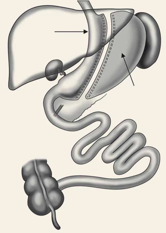 Sleeve gastrectomy.
Fig. 2. Sleeve gastrectomy.