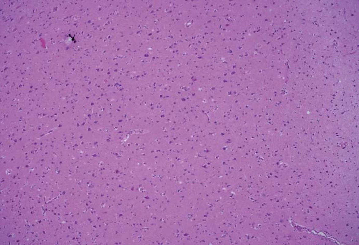 Histologický preparát z tkáně bez pozitivní fluorescence, bez přítomnosti nádorových elementů.
Fig. 3. A histological slide from the tissue with no fluorescence and with no tumor elements.