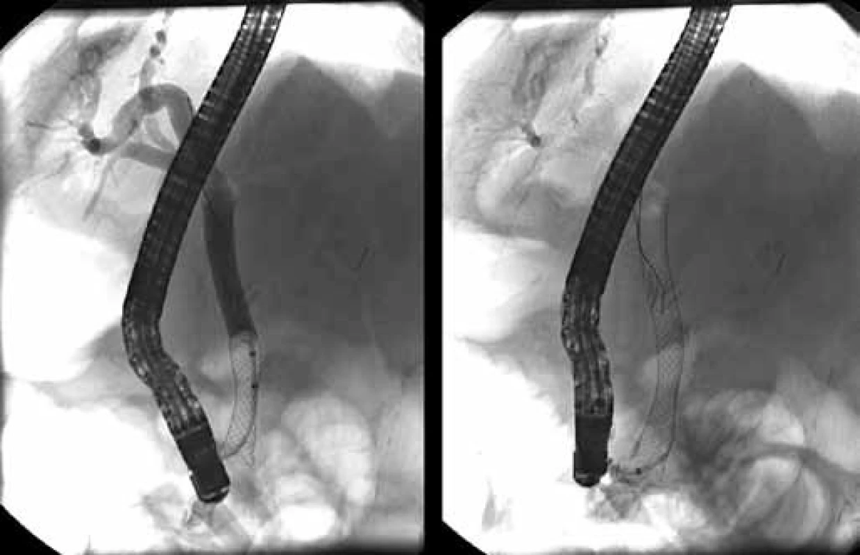 Pri kontrolnom ERCP, jeden deň po zavedení biliárneho metalického stentu, nie je prítomný únik žlče. 
Fig. 6. Not visible bile leak one day after insertion of biliary fully covered self-expandable metallic stent.