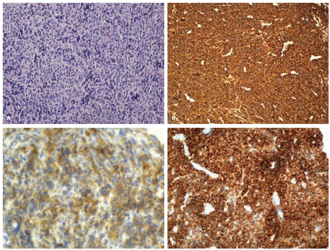 Série vybraných imunohistochemických vyšetření tkáně PMBCL, barveno hematoxylin-eozinem (A), CD20 (B), CD30 (C), CD19 (D).