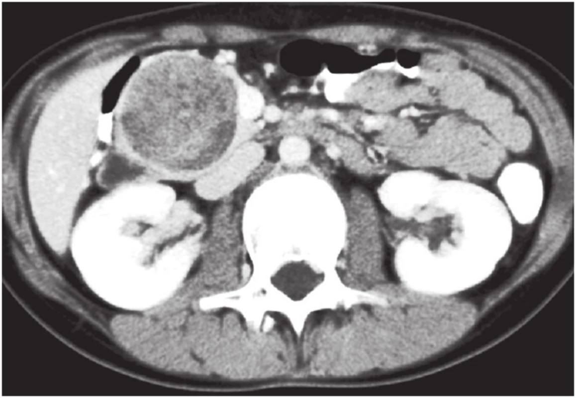 CT, dívka, 11 let, solidní pseudopapilární tumor hlavy pankreatu, provedena duodenum šetřící resekce hlavy pankreatu, 8,5 let po operaci, v dobrém stavu
Fig. 1: CT, girl, age 11, solid pseudopapillary tumor of the pancreatic head, duodenum-preserving head resection was performed, 8.5 years after surgery, in a good condition