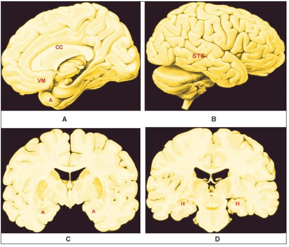 A – D.
Přibližná poloha oblastí mozku, jejichž strukturální a funkční odchylky korelují psychopatii
Legenda:
A – Vnitřní plocha pravé hemisféry;
B – Zevní plocha pravé hemisféry;
C – Řez v čelní rovině na úrovni amygdaly;
D – Řez v čelní rovina na úrovni s. nigra;
CC – corpus callosum;
VM – ventromediální prefrontální kůra;
A – amygdala;
STS – kůra sulcus temporalis superior;
H – hipokampus;