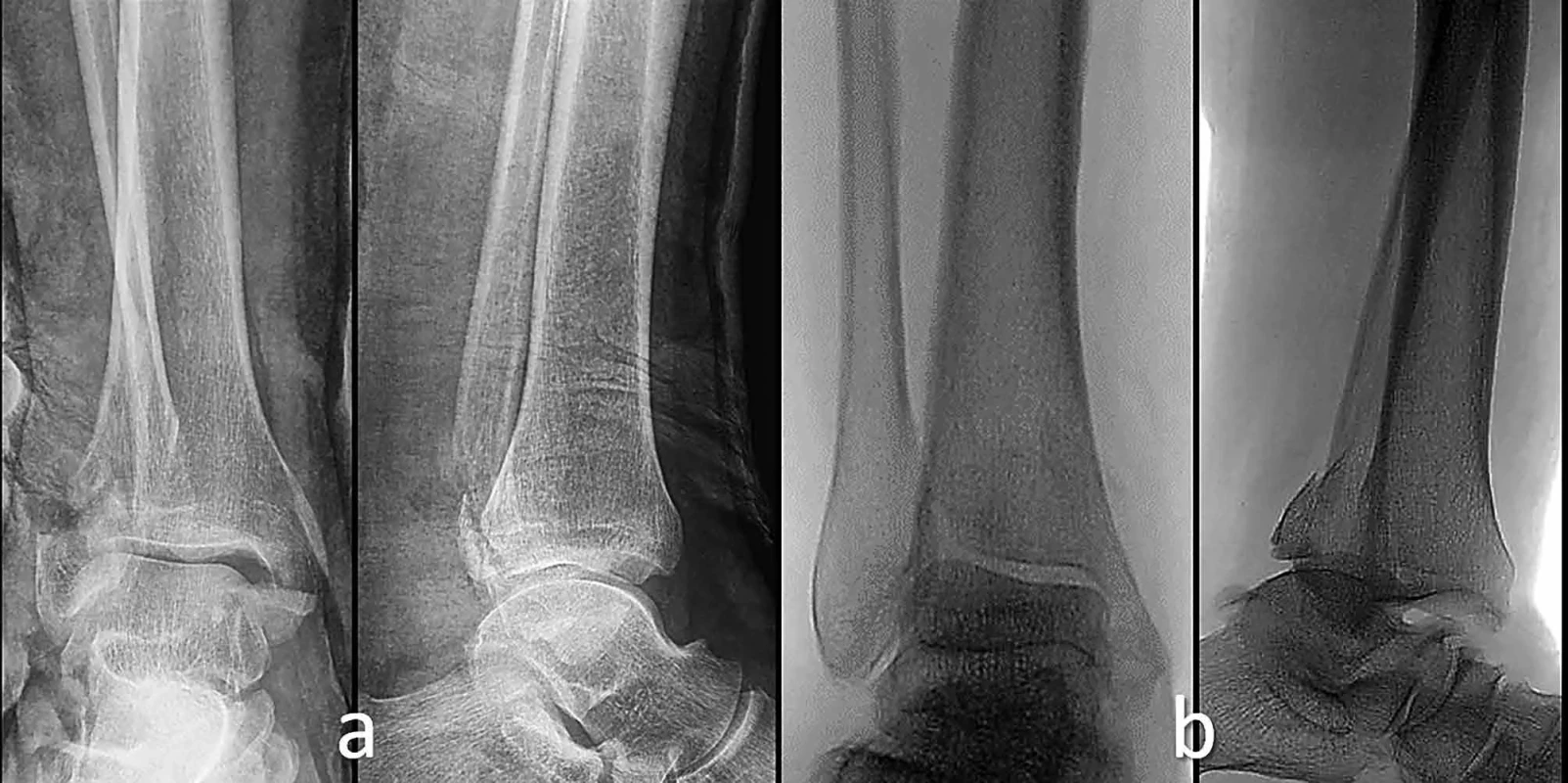 Srovnání rtg snímků u Bosworthovy zlomeniny se zlomeninou fibuly Weber B a Weber C </br> arison of radiographs of a Bosworth fracture with fibula fractures of types Weber B and Weber C