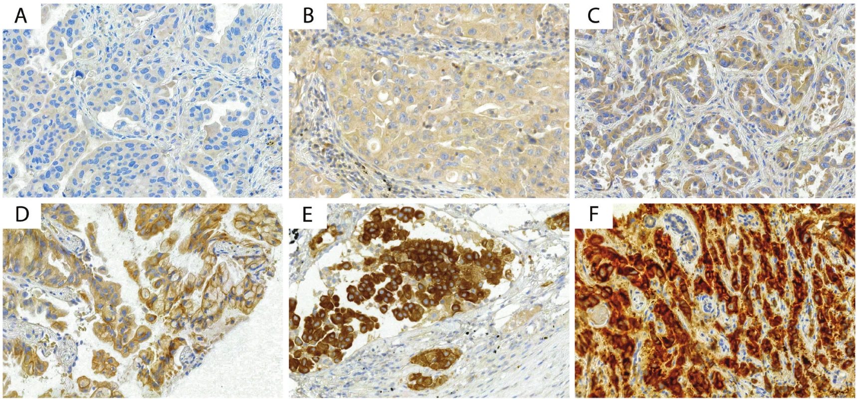 Rozdílná intenzita exprese ALK proteinu v nádorových buňkách (A intenzita 0+, B intenzita 1+, C intenzita 1-2+, D intenzita 2+, E intenzita 2-3+, F intenzita 3+, klon D5F3, ředění 1:100, Cell Signaling Technology, Danvers, MA, USA, zvětšení 400x).