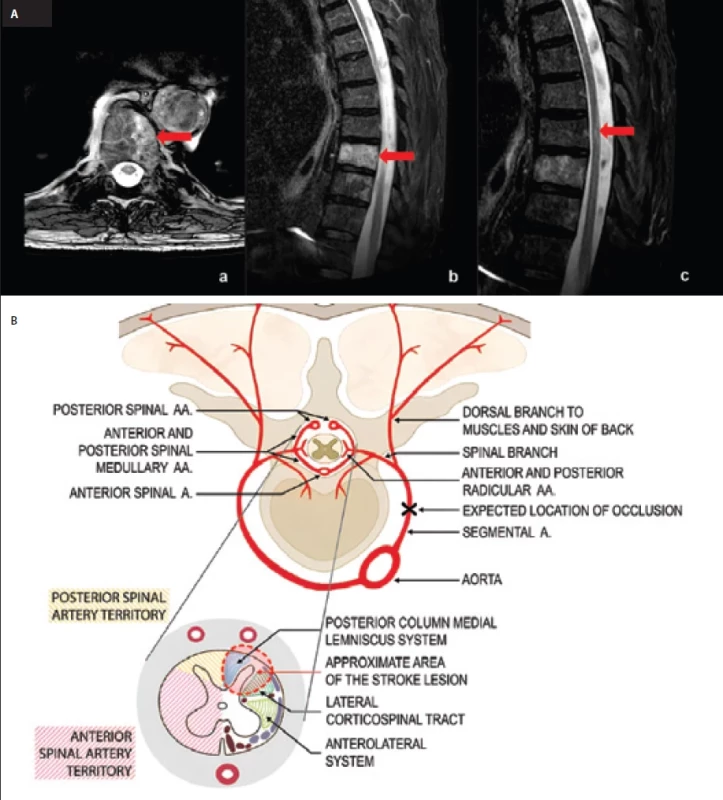 (A) MRI – newly observed pathological signal (red arrow) in the left half of the vertebral body at the level of T9, indicating changes related to a bone infarct: (a) balanced turbo fi eld-echo (B_TFE) sequence in the transverse plane, (b) STIR sequence in the sagittal plane. Discrete spinal cord inhomogeneities are seen on the STIR sequence at the T8 vertebra level (c). (B) Arterial blood supply to the spinal cord and thoracic vertebrae.