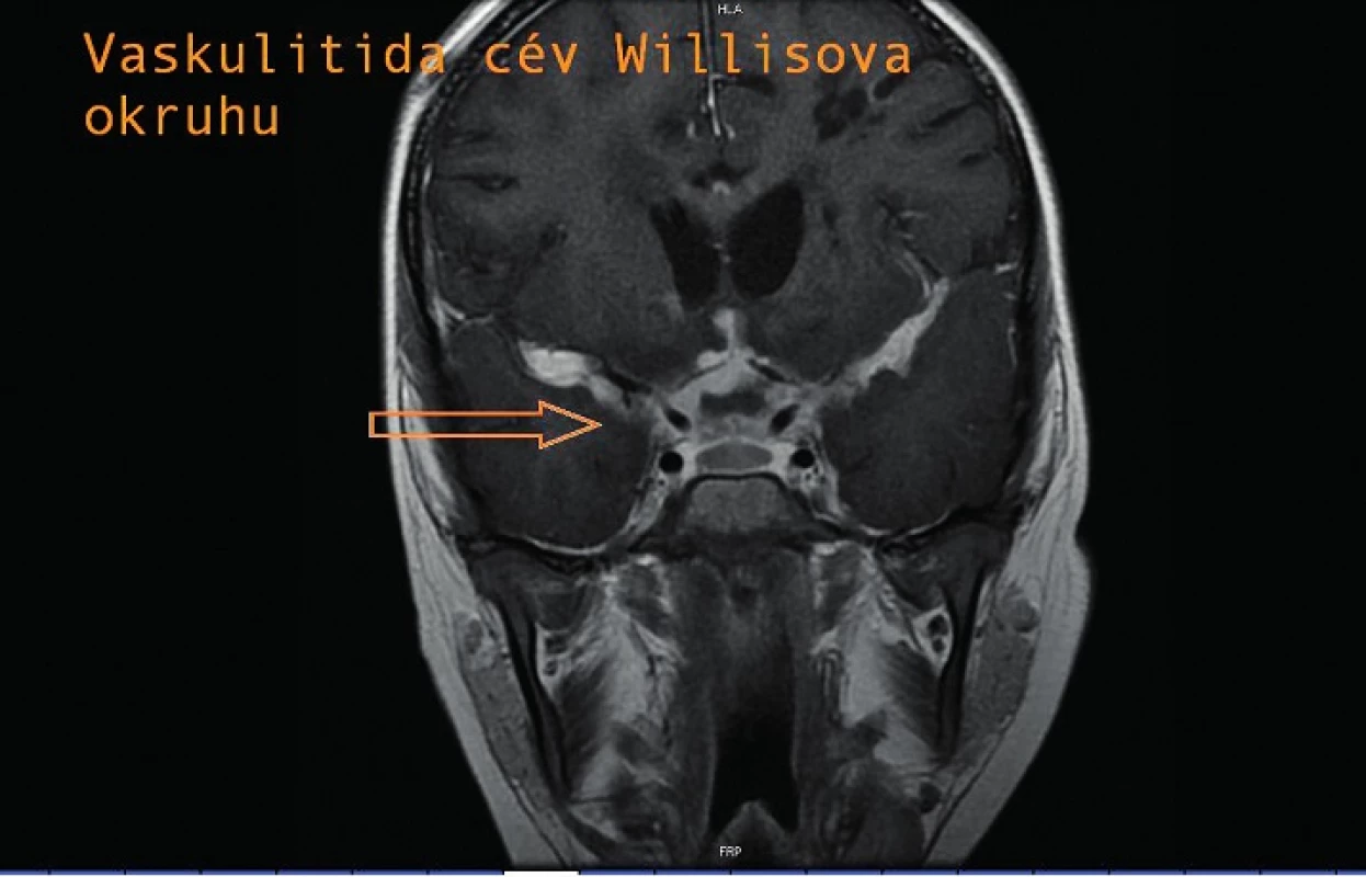 Vaskulitida cév Willisova okruhu.
Fig. 4. Vasculitis of vessels of the circle of Willis.