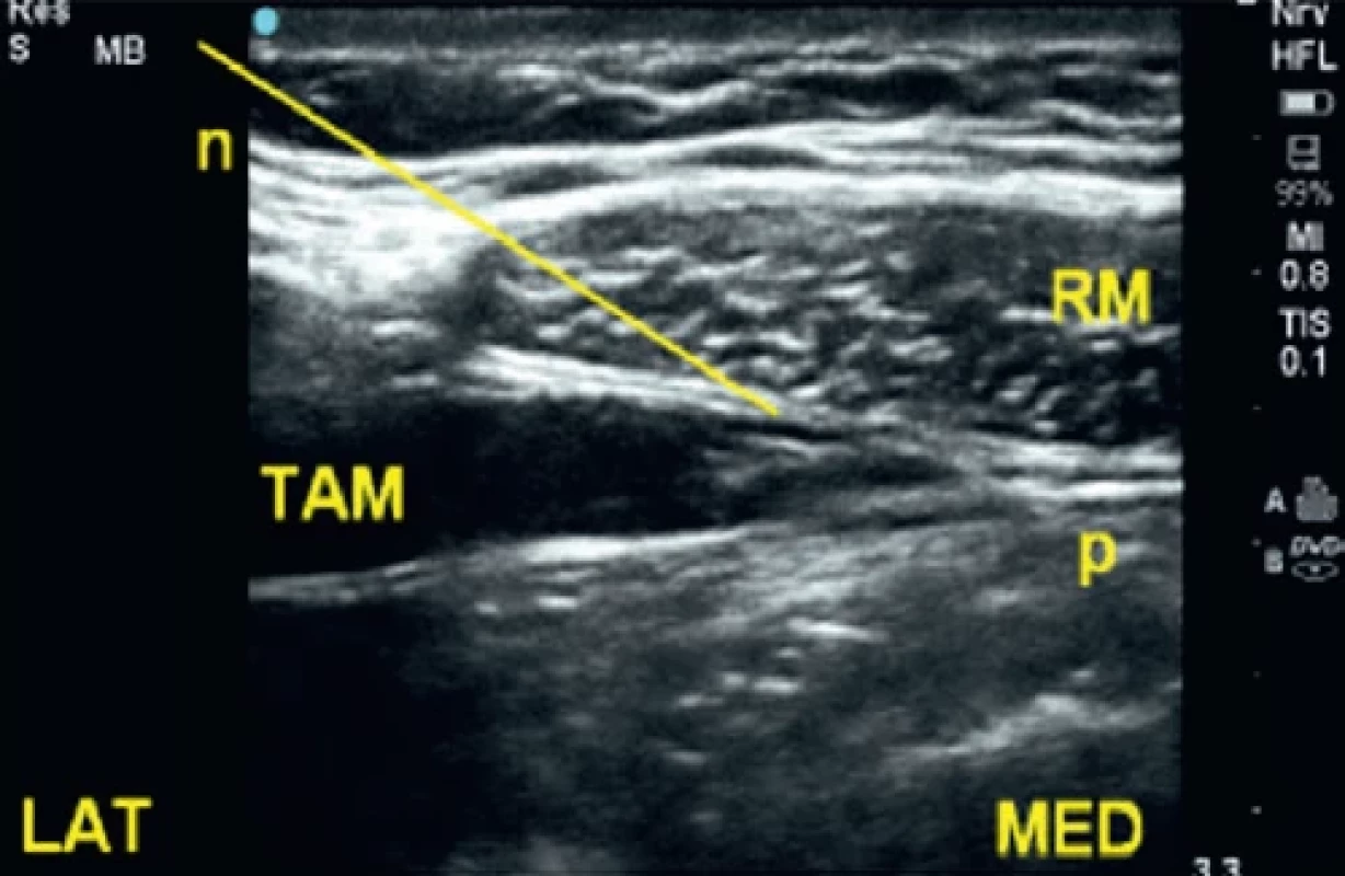Rovina mezi m. transversus abdominis a m. rectus (TRAP) v subkostální oblasti [28,29].