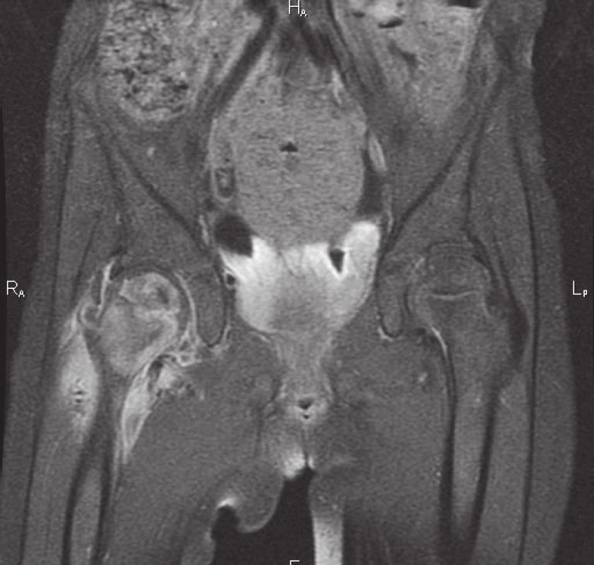 Nález na MRI 4 týdny od prvních projevů infekce <i>M. avium</i>: edém proximálního femuru a přilehlých měkkých tkání, v osifikačním jádru hlavice nekróza, kraniálně absces, nekróza v mediální části krčku.
Fig. 4. MRI imaging 4 weeks after the onset of symptoms of <i>M. avium</i> infection: proximal femur and adjacent soft tissue oedema, necrosis in ossification centre and abscess of right femoral head, necrosis in medial aspect of right femoral neck.