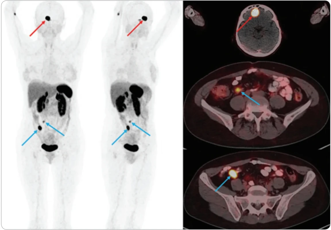 68Ga-DOTATOC PET/CT – MIP v přední a šikmé projekci v černobílé barevné škále (vlevo), detaily fúzovaných axiálních řezů na ložiska s vysokou expresí somatostatinových receptorů (vpravo). Primární NET terminálního ilea a metastáza frontálně vlevo (červené šipky) a v pravé jámě kyčelní (modré šipky). Fyziologické akumulace: hypofýza, slezina, nadledviny, processus uncinatus slinivky a dále ledviny a močový měchýř při vylučování radiofarmaka.