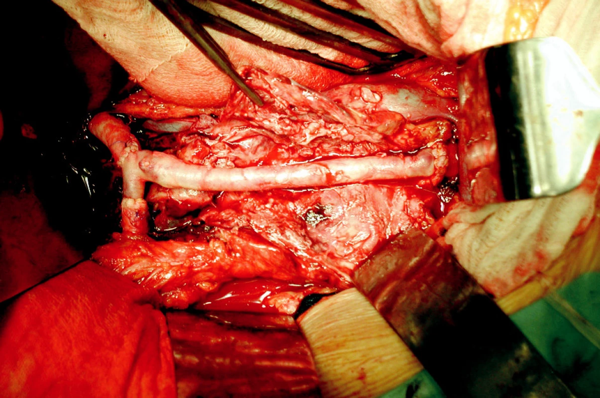 Aorto-biiliakální rekonstrukce autologní vénou femoralis superficialis
Fig. 4. Aorto-biiliac reconstruction by an autologous superficial femoral vein graft