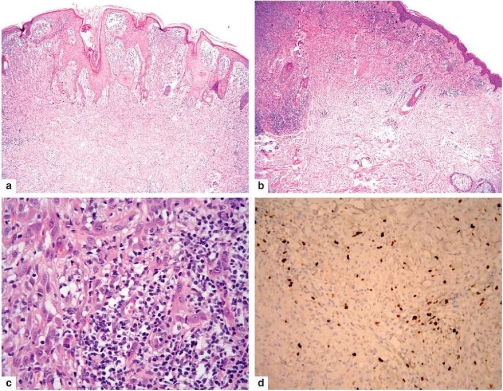 Spitzoidní melanom
a – verukózní tumor s nepravidelně hyperplastickou epidermis
b – dosti husté infiltráty lymfocytů v něm
c – v nich jsou melanocyty s hyperchromními jádry a prominujícími jadérky
d – tyto vykazují vysokou proliferační aktivitu i v dolní části léze (Ki-67)