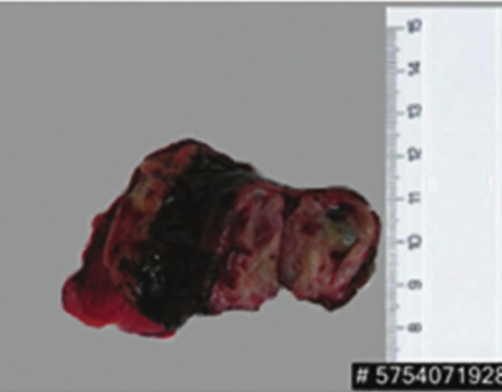 Levostranná adrenalektomie
Fig. 8: Left adrenalectomy