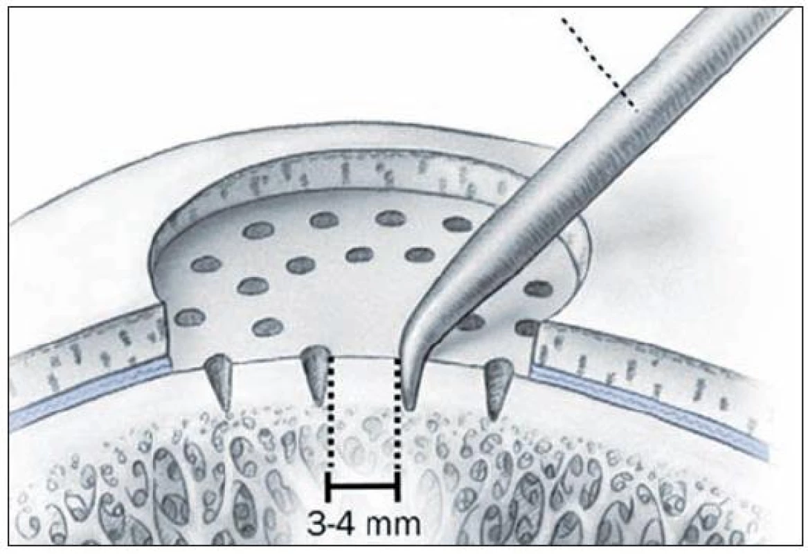 Stimulácia kostnej drene: Mikrofraktúry – podstatou výkonu je perforácia subchondrálnej kosti (reprodukcia z Mithoefer K, Williams RJ, Potter HG, et al. Chondral resurfacing of articular cartilage defects in the knee with microfracture technique. J Bone Joint Surg Am 2006, 88: 294–304)