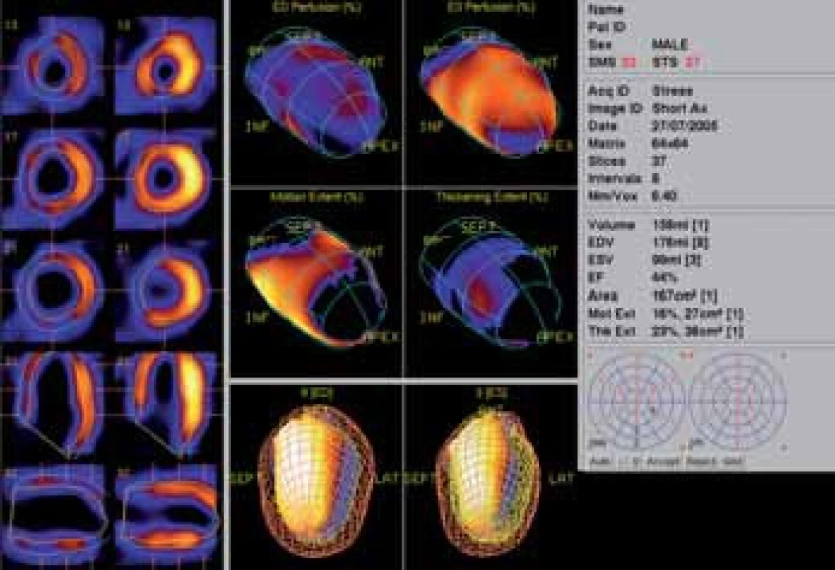 Funkční parametry po zátěži a v klidu. Na horních obrázcích rozsáhlá porucha perfuze v enddiastole a v end systole. Uprostřed porucha kinetiky a porucha systolického ztlušťování na přední stěně.