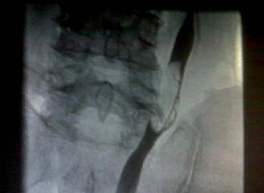 Retrográdní ureteropyelogram prokazuje přítomnost tumoru v močovodu o velikosti 3 cm.
