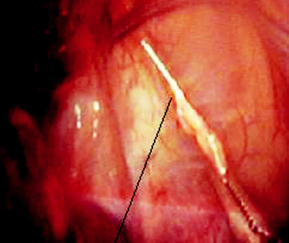 Exstirpace cizího tělesa
Fig. 7. Extirpation of the foreign body