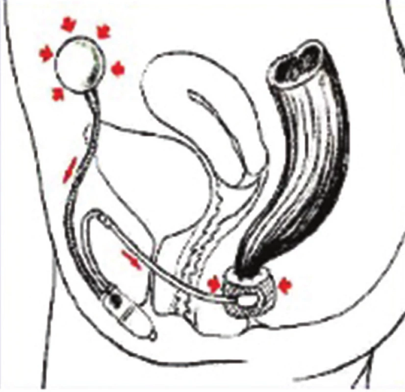 Umělý svěrač anu Acticon Neosphincter – schematické znázornění umístění a funkce
Fig. 2: Artificial anal sphincter Acticon Neosphincter – placement and function