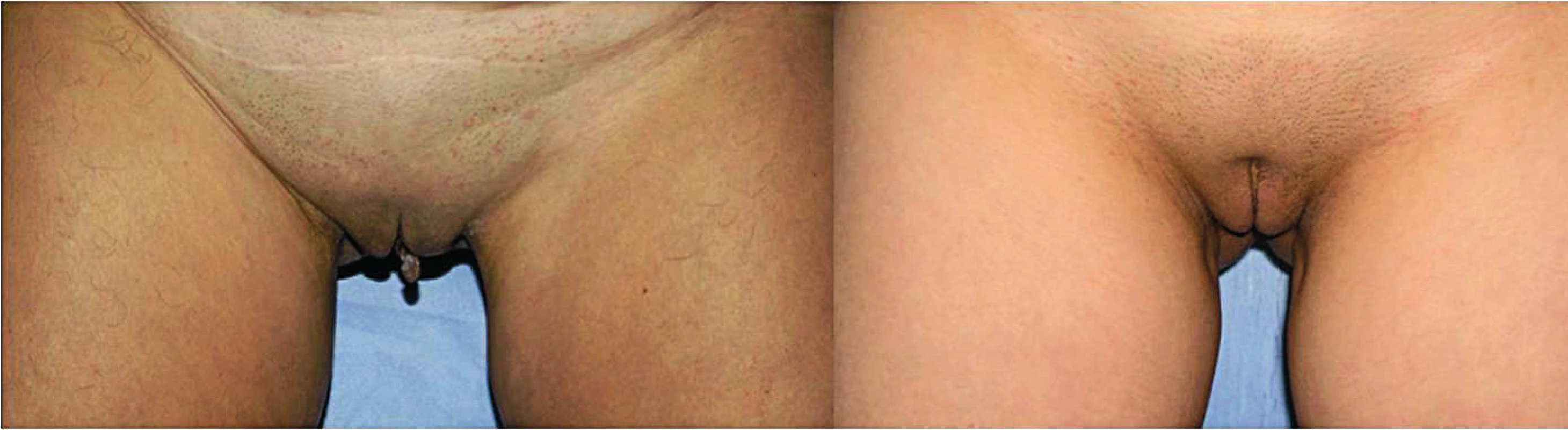 (Left) Preoperative view in a 22 years old patient standing. (Right) Post-operative view at 15 months