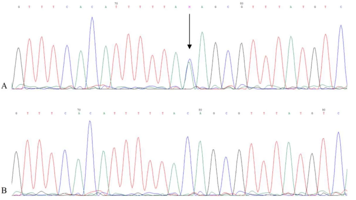The partial electropherograms of the borderline between the intron 5 and the exon 6 of the SGCE gene (NM_003919.2). The heterozygous variant c.663-3C>A is indicated by the arrow (forward strand).  A – partial electropherogram of the proband; B – partial electropherogram of the control sequence