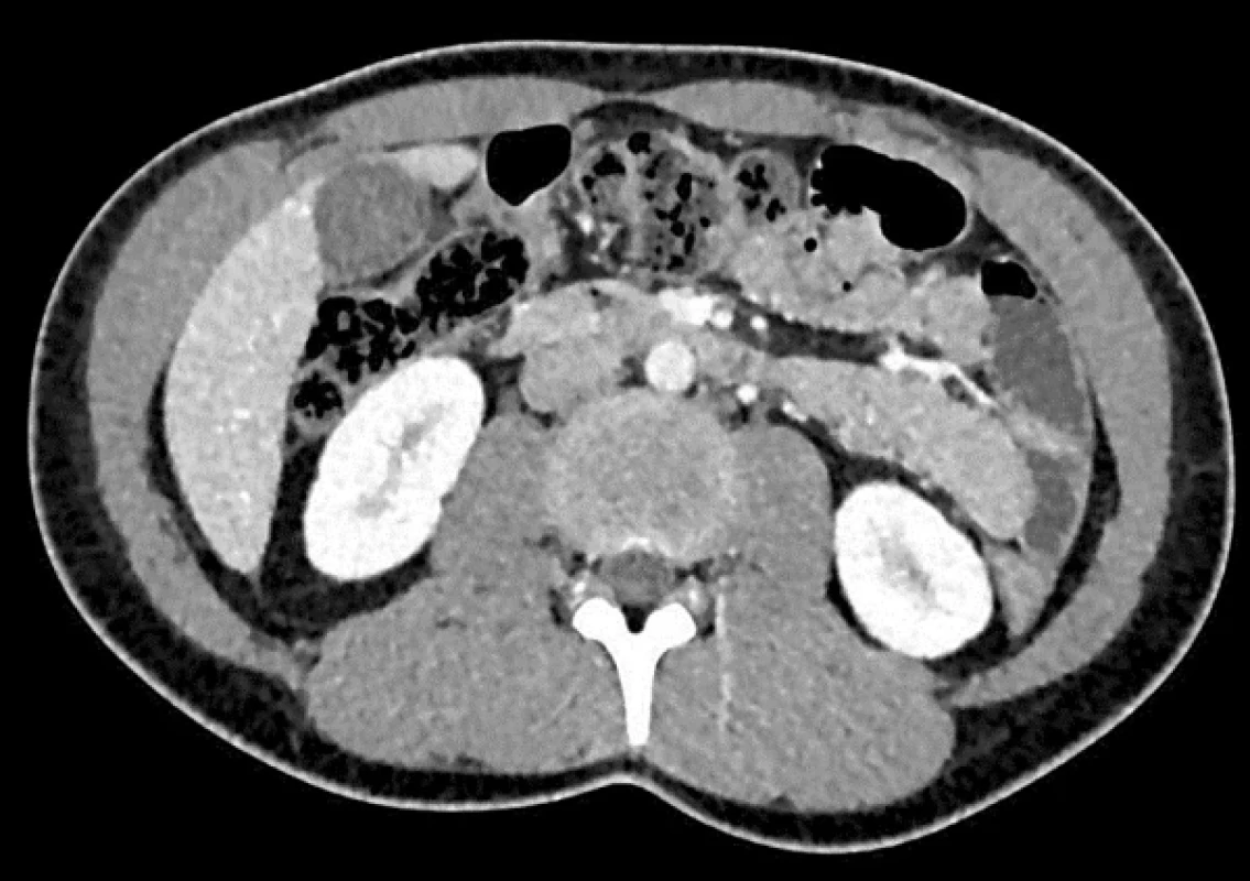 Alveolární echinokokóza na CT – segment VII–VIII