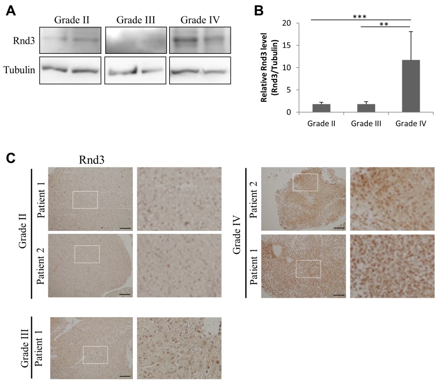 RND3 is up-regulated in grade IV glioma.