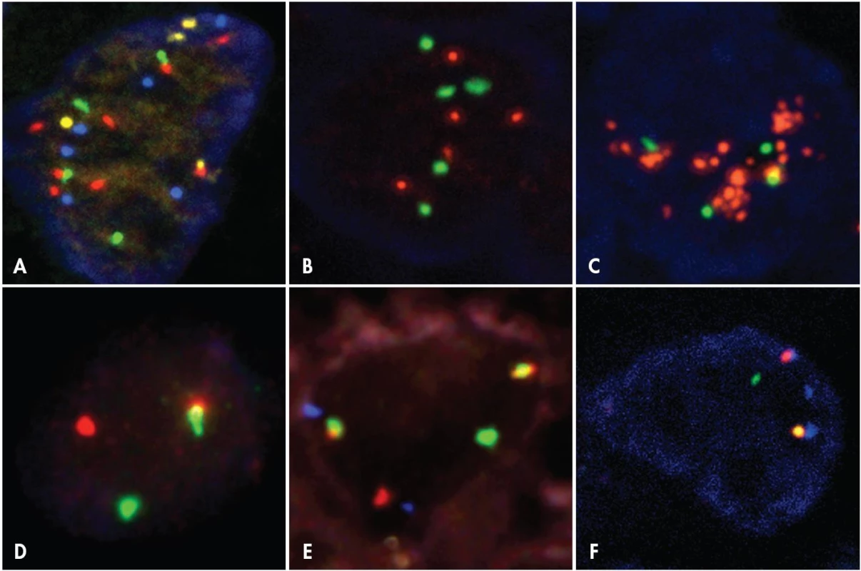 Příklady výsledků I-FISH na histologických řezech – jednotlivá jádra nádorových buněk
A. <em>Melanom s komplexními změnami</em> – 8 signálů genu <em>RREB1</em> (Spectrum Red), 4 signály genu <em>MYB</em> (Spectrum Gold), 4 signály genu <em>CCND1</em> (Spectrum Green), 6 signálů pro centromeru chromozomu 6 (Spectrum Aqua), jádro dobarveno DAPI (Vysis). B. <em>Invazivní duktální karcinom mléčné žlázy s polyzomií chromozomu 17</em> – 5 signálů genu <em>ERBB2</em> (Red fluorochrome), 5 signálů pro centromeru chromozomu 17 (Green fluorochrome), jádro dobarveno DAPI (Pan Path). C. <em>Invazivní duktální karcinom mléčné žlázy s amplifikací genu ERBB2 a polyzomií chromozomu 17</em> – gen <em>ERBB2</em> (Red fluorochrome), centromera chromozomu 17 (Green fluorochrome), jádro dobarveno DAPI (Pan Path). D. <em>Burkittův lymfom se zlomem v oblasti genu MYC</em> – systém „dual color break-apart“, ZyGreen (sonda nasedající za místo zlomu genu <em>MYC</em> směrem k telomeře) a ZyOrange (sonda nasedající za místo zlomu genu <em>MYC</em> směrem k centromeře), jádro dobarveno DAPI (Zyto Vision). E. <em>Burkittův lymfom s translokací t(8;14)(q24;q32)</em> – systém „dual color dual fusion“ s přidanou sondou centromerickou, gen <em>MYC</em> (Spectrum Orange), gen <em>IGH</em> (Spectrum Green), centromera chromozomu 8 (Spectrum Aqua), (Vysis). F. <em>Karcinom plic s inverzí inv(2 (p21p23)</em> – gen <em>ALK</em> (ZyGreen – sonda nasedající za místo zlomu <em>ALK</em> genu směrem k centromeře a ZyRed – sonda nasedající za místo zlomu <em>ALK</em> genu směrem k telomeře; při inverzi jsou zelené a červené signály oddáleny), gen <em>EML4</em> (ZyBlue – sonda překrývající oblast před i za místem zlomu genu <em>EML4</em>, při inverzi vznikají dva signály), jádro dobarveno DAPI (Zyto Vision). Vzdálenost mezi oddáleným zeleným a červeným signálem je v případě paracentrické inverze menší než u zlomu genu a translokaci na jiný chromozom, jak je vidět při porovnání obr 4D a 4F.