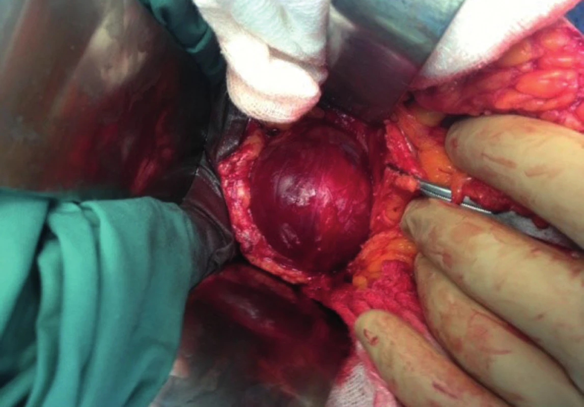 Peroperační nález schwannomu
Fig. 2: Intraoperative finding of schwannoma