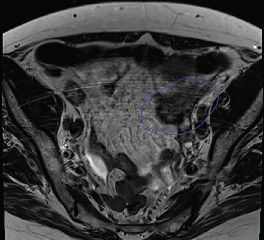 MRI pánve