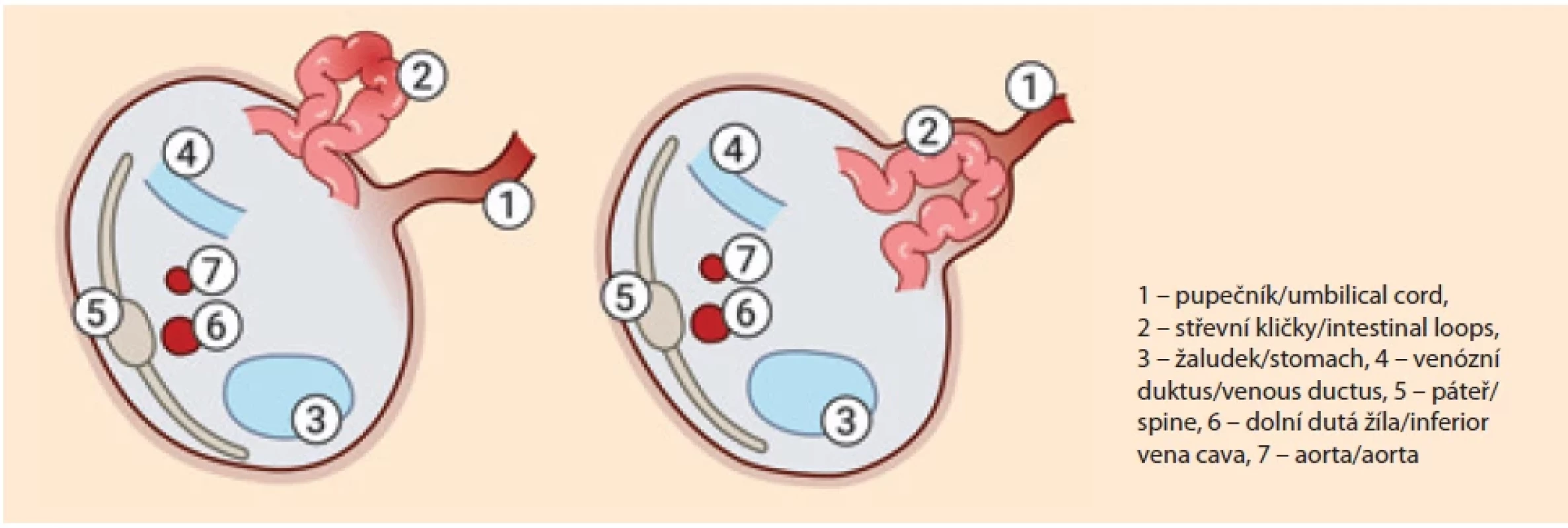 Ultrazvuková charakteristika gastroschízy a omfalokély v transverzálním řezu.